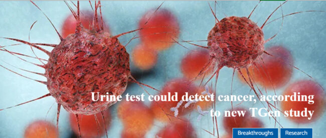 City of Hope Urine Test for Cancer